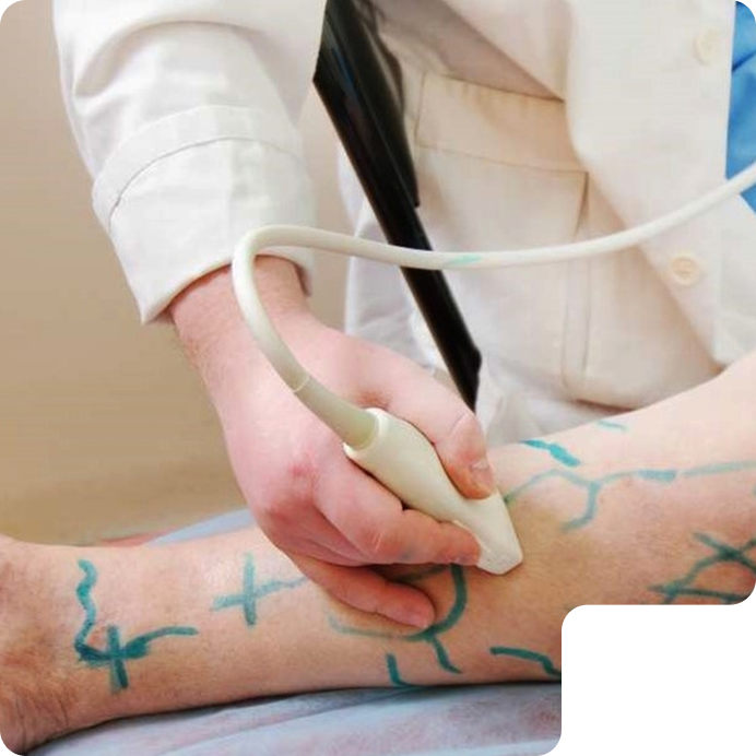Mapeamento de varizes com ultrassom e marcação na perna