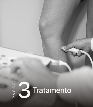 Etapa 3: tratamento de varizes minimamente invasivo