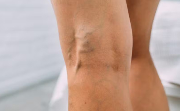 Perna com veias dilatadas e inchaço