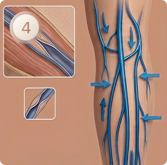 Ilustração da veia tratada após o laser endovenoso, etapa 4