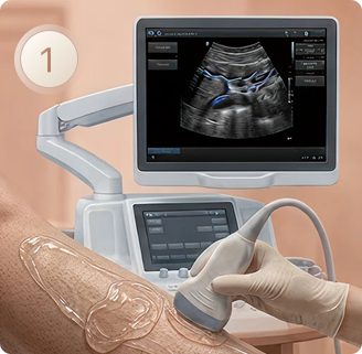 Etapa 1 do laser endovenoso: mapeamento da veia com ultrassom