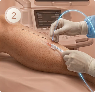 Etapa 2 do laser endovenoso: punção da veia guiada por ultrassom