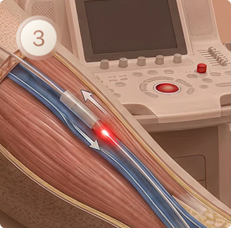 Etapa 3 do laser endovenoso: fibra de laser dentro da veia safena