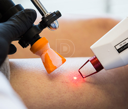 Laser transdérmico aplicado na perna no tratamento de vasinhos com CLaCS