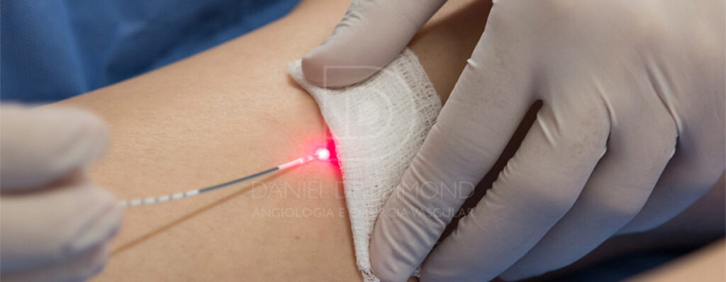 Fibra de laser endovenoso inserida na perna durante o tratamento de varizes
