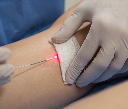 Fibra de laser endovenoso no tratamento de varizes sem cortes