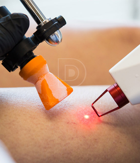 Aplicação de laser na pele para tratar vasinhos com a técnica CLaCS